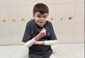 Leo, el niño con “piel de mariposa”, accede a una terapia génica que cambia su vida
